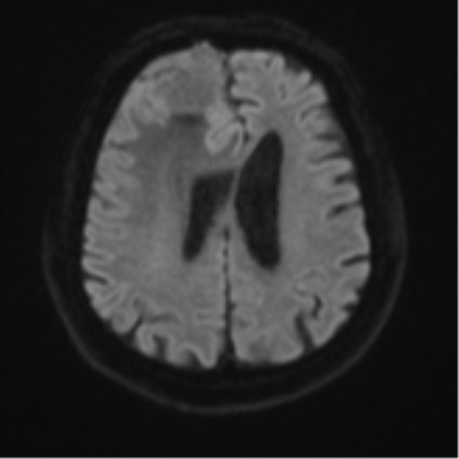 Atypical meningioma (WHO grade II) with brain invasion (Radiopaedia 57767-64729 Axial DWI 50).png