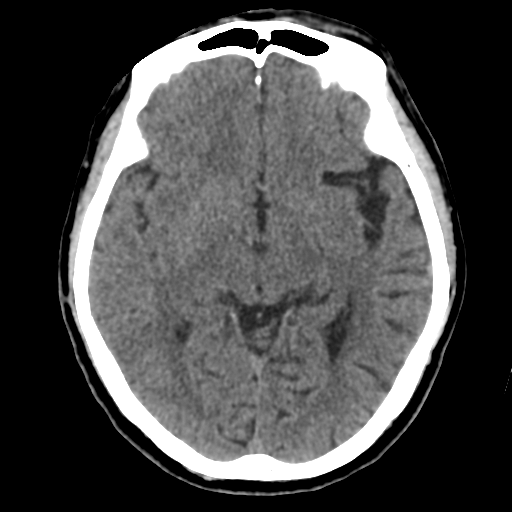 Atypical meningioma (WHO grade II) with osseous invasion (Radiopaedia 53654-59715 Axial non-contrast 25).png