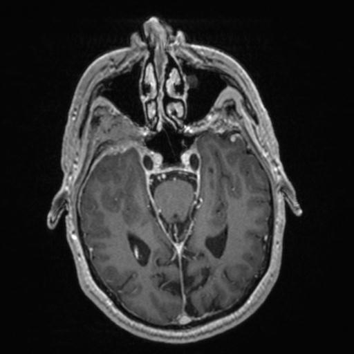 Atypical meningioma (grade II) - en plaque (Radiopaedia 29633-30147 Axial T1 C+ 73).jpg