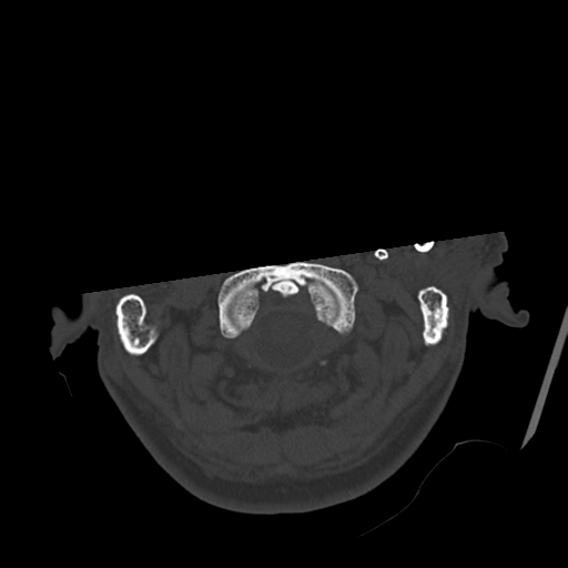 Atypical meningioma with skull invasion (Radiopaedia 34357-35649 Axial bone window 7).png