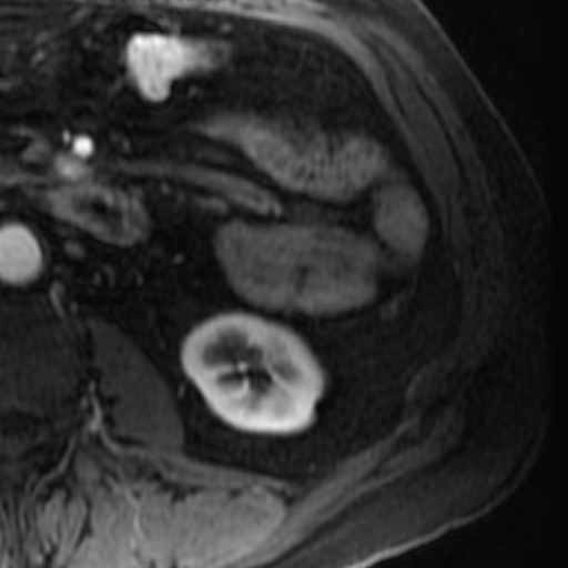 File:Atypical renal cyst on MRI (Radiopaedia 17349-17046 C 25).jpg