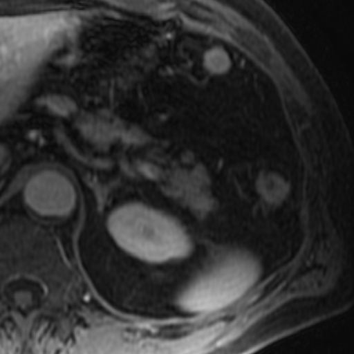 File:Atypical renal cyst on MRI (Radiopaedia 17349-17046 D 5).jpg