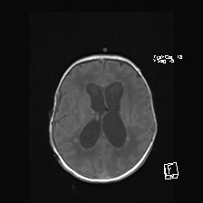 Atypical teratoid rhabdoid tumor (prenatal US and neonatal MRI) (Radiopaedia 59091-66388 Axial T1 37).jpg