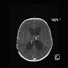 Atypical teratoid rhabdoid tumor (prenatal US and neonatal MRI) (Radiopaedia 59091-66388 Axial T1 C+ 37).jpg