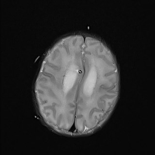 File:Atypical teratoid rhabdoid tumor (prenatal US and neonatal MRI) (Radiopaedia 59091-66388 Axial T2 23).jpg