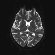 Autoimmune limbic encephalitis (Radiopaedia 30363-31005 Axial B0 and DWI 18).jpg