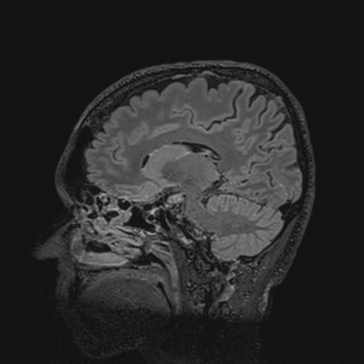 Autoimmune limbic encephalitis (Radiopaedia 30363-31005 Sagittal FLAIR 69).jpg