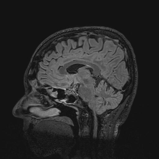 Autoimmune limbic encephalitis (Radiopaedia 30363-31005 Sagittal FLAIR 76).jpg