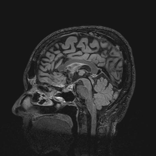 Autoimmune limbic encephalitis (Radiopaedia 30363-31005 Sagittal FLAIR 81).jpg