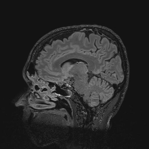 Autoimmune limbic encephalitis (Radiopaedia 30363-31005 Sagittal FLAIR 89).jpg