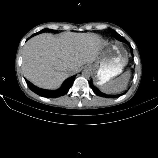 Autoimmune pancreatitis (Radiopaedia 84925-100431 Axial non-contrast 10).jpg