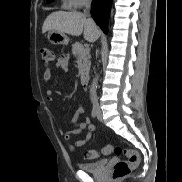 File:Autosomal dominant polycystic kidney disease (Radiopaedia 36539-38101 D 42).jpg