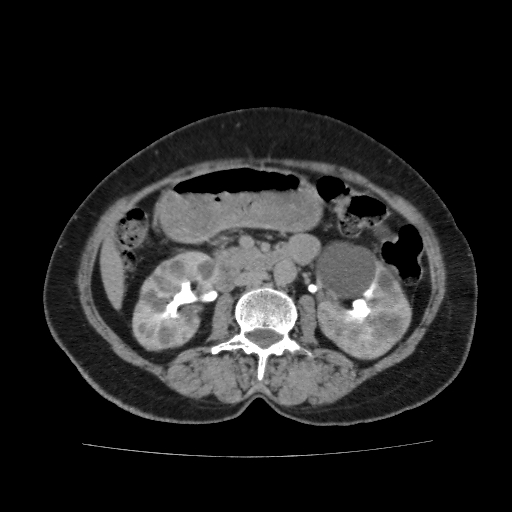 Autosomal dominant polycystic kidney disease (Radiopaedia 38189-40194 Axial C+ delayed 23).jpg