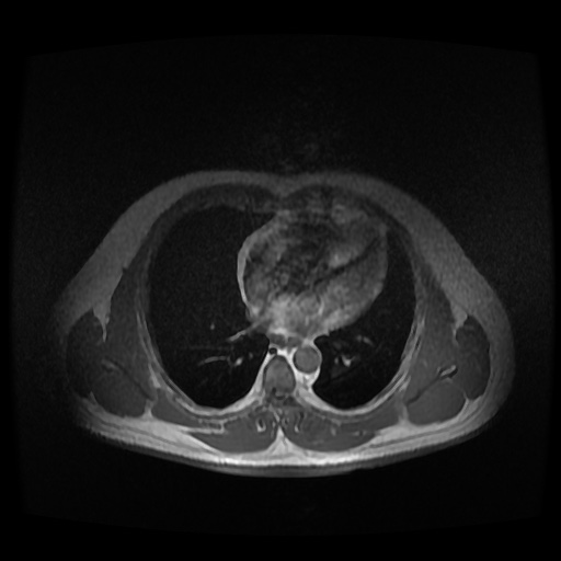 Autosomal dominant polycystic kidney disease (Radiopaedia 50259-55611 Axial 2D Dual Echo 2).jpg