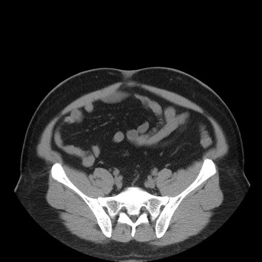 File:Autosomal dominant polycystic kidney disease (Radiopaedia 50259-55612 Axial non-contrast 64).jpg