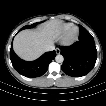 Autosomal dominant polycystic kidney disease (Radiopaedia 66349-75582 B 7).jpg