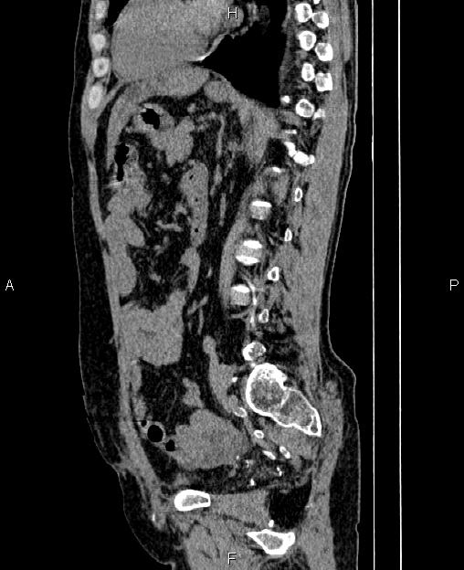 Autosomal dominant polycystic kidney disease (Radiopaedia 87830-104287 C 56).jpg