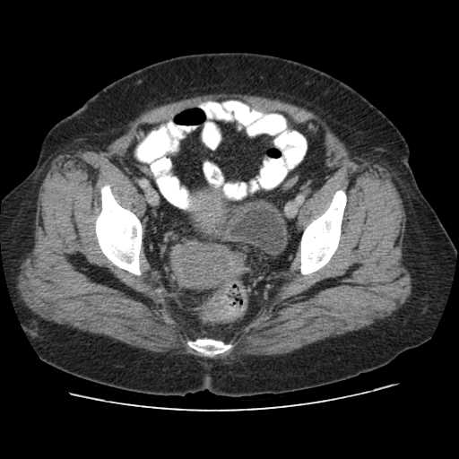 Autosomal dominant polycystic kidney disease with hepatic involvement (Radiopaedia 32693-33662 B 73).jpg