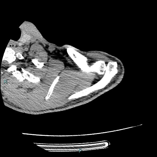 File:Avascular necrosis after fracture dislocations of the proximal humerus (Radiopaedia 88078-104655 D 27).jpg