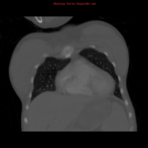 Avascular necrosis in sickle cell disease (Radiopaedia 17448-17152 Coronal bone window 30).jpg