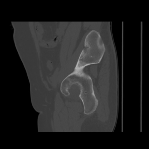 Avascular necrosis of the hip (Radiopaedia 61503-69467 B 42).jpg