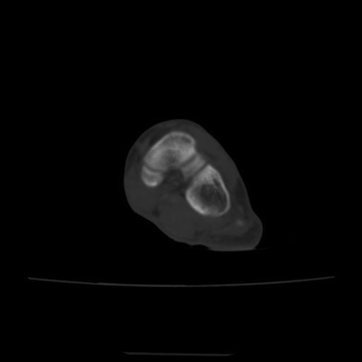 Avulsion fracture of the dorsal cuboid bone (Radiopaedia 51586-57377 Axial bone window 89).jpg