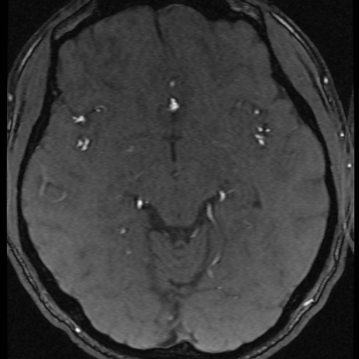 Azygos anterior cerebral artery (Radiopaedia 17059-16756 Axial MRA 33).jpg