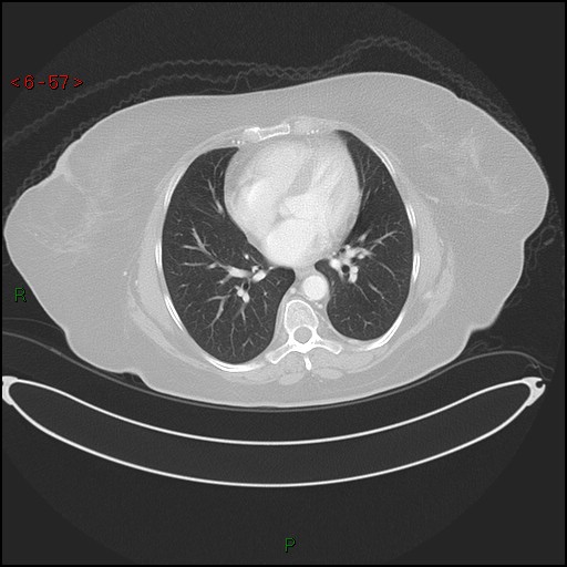 File:Azygos fissure and lobe (Radiopaedia 47620-52278 Axial lung window 57).jpg