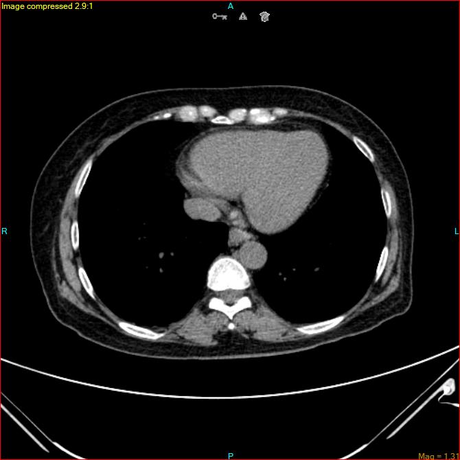 Azygos vein aneurysm (Radiopaedia 77824-90130 A 41).jpg