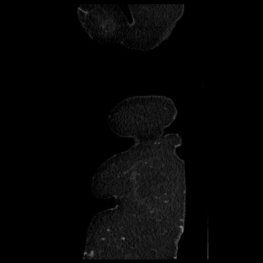 B-cell lymphoma of the mesentery (Radiopaedia 65711-74827 C 19).jpg
