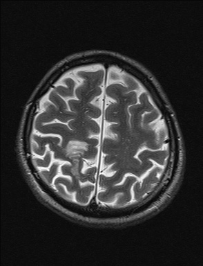 File:Balo concentric sclerosis (Radiopaedia 50458-55940 Axial T2 9).jpg