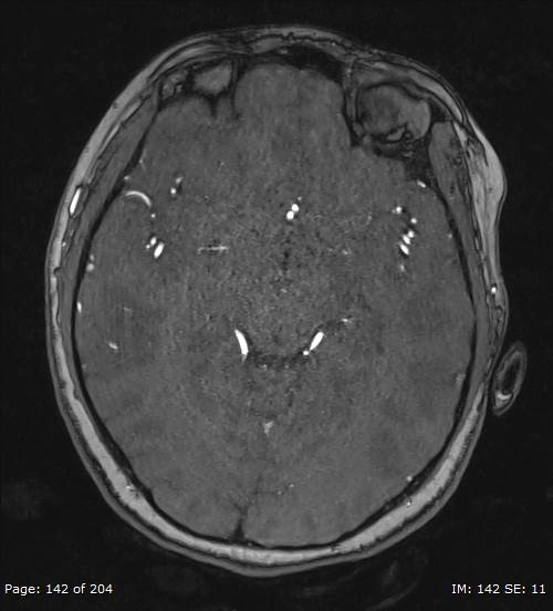 Balo concentric sclerosis (Radiopaedia 61637-69636 Axial MRA 142).jpg