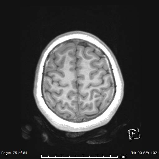 File:Balo concentric sclerosis (Radiopaedia 61637-69636 Axial T1 75).jpg
