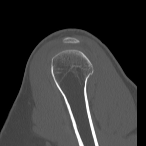 Bankart lesion (Radiopaedia 57256-64185 Sagittal bone window 14).jpg