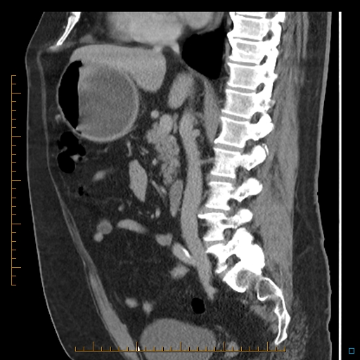 File:Bariatric balloon causing gastric outlet obstruction (Radiopaedia 54449-60672 C 45).jpg