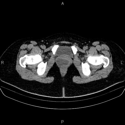 Bartholin gland cyst (Radiopaedia 62635-70930 Axial non-contrast 78).jpg