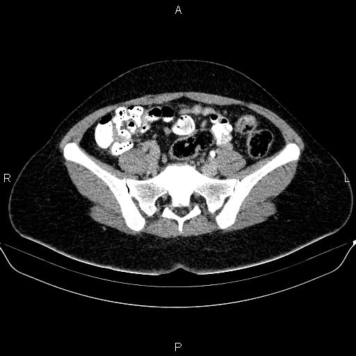 Bartholin gland cyst (Radiopaedia 62635-70930 C 21).jpg