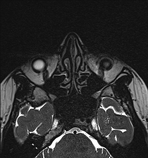 Basal cell carcinoma - nasal region (Radiopaedia 70292-80365 Axial Gradient Echo 54).jpg