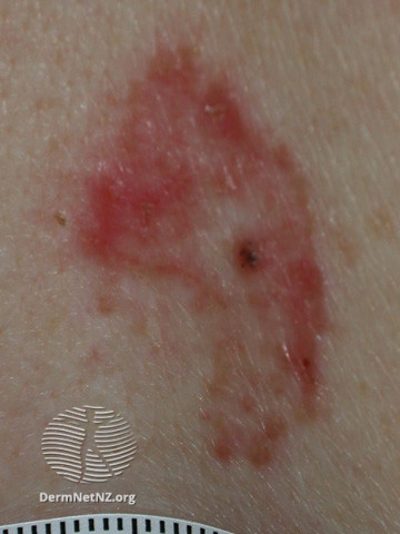 File:Basal cell carcinoma affecting the trunk (DermNet NZ lesions-bcc-trunk-1017).jpg