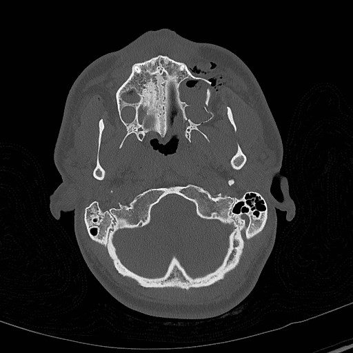 Base of skull fracture with bilateral Le Fort fractures (Radiopaedia 47094-51638 Axial bone window 19).jpg