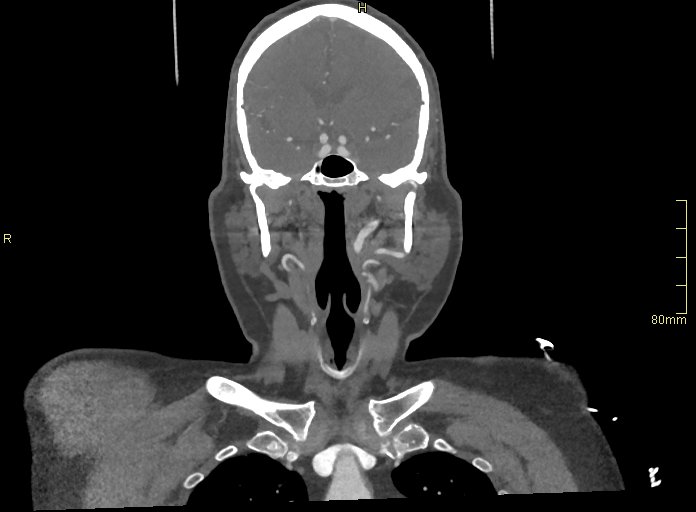 Basilar artery aneurysm (Radiopaedia 56261-62932 B 10).jpg