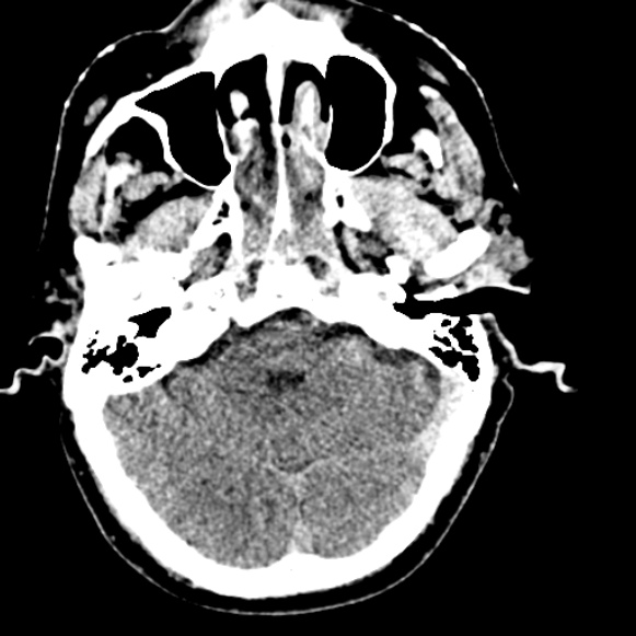 Basilar artery thrombosis (Radiopaedia 53351-59333 Axial non-contrast 38).jpg