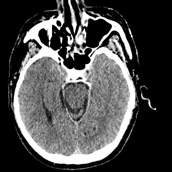 Basilar artery thrombosis (Radiopaedia 53351-59333 Axial non-contrast 51).jpg
