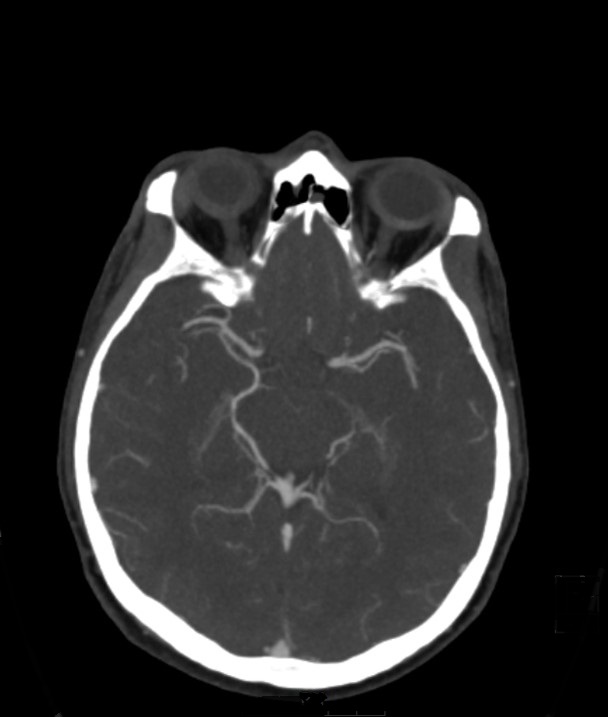 Basilar artery thrombosis and ascending transtentorial herniation (Radiopaedia 84759-100360 B 31).jpg