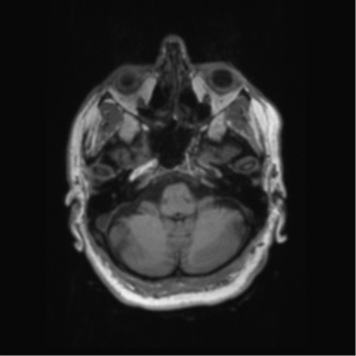 File:Behavioral variant frontotemporal dementia and late onset schizophrenia (Radiopaedia 52197-58083 Axial T1 89).png