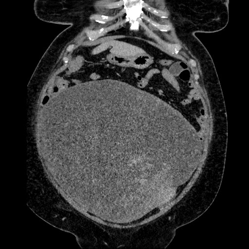Benign leiomyoma with hydropic features (Radiopaedia 89250-106130 B 41).jpg