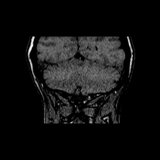 File:Berry aneurysm of the terminal internal carotid artery (Radiopaedia 88286-104918 Coronal TOF 100).jpg