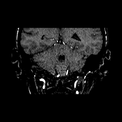 File:Berry aneurysm of the terminal internal carotid artery (Radiopaedia 88286-104918 Coronal TOF 77).jpg