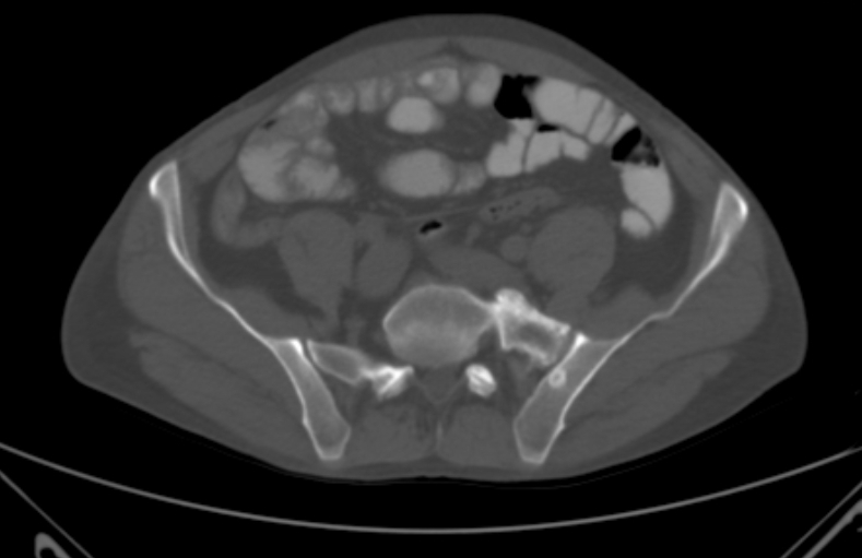 File:Bertolotti syndrome (Radiopaedia 58974-66235 Axial bone window 9).jpg