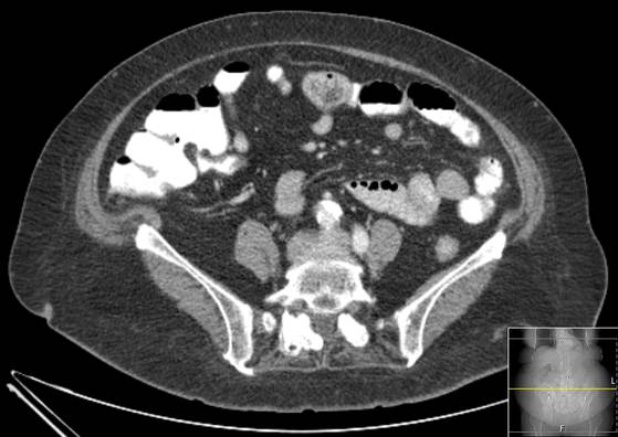 Bicameral celiacomesenteric aneurysm (Radiopaedia 55766-62327 A 43).jpg